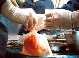 Las: Istraga trgovine organima kompleksna, sledićemo dokaze