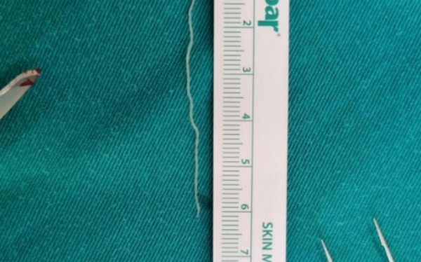 Banjaluka: Doktor Kozomara objavio fotografiju - iz kapka pacijenta odstranjen crv od 6 cm