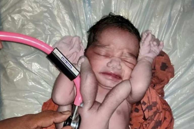 Indija: Bebu rođenu sa četiri ruke i noge proglasili reinkarnacijom Boga