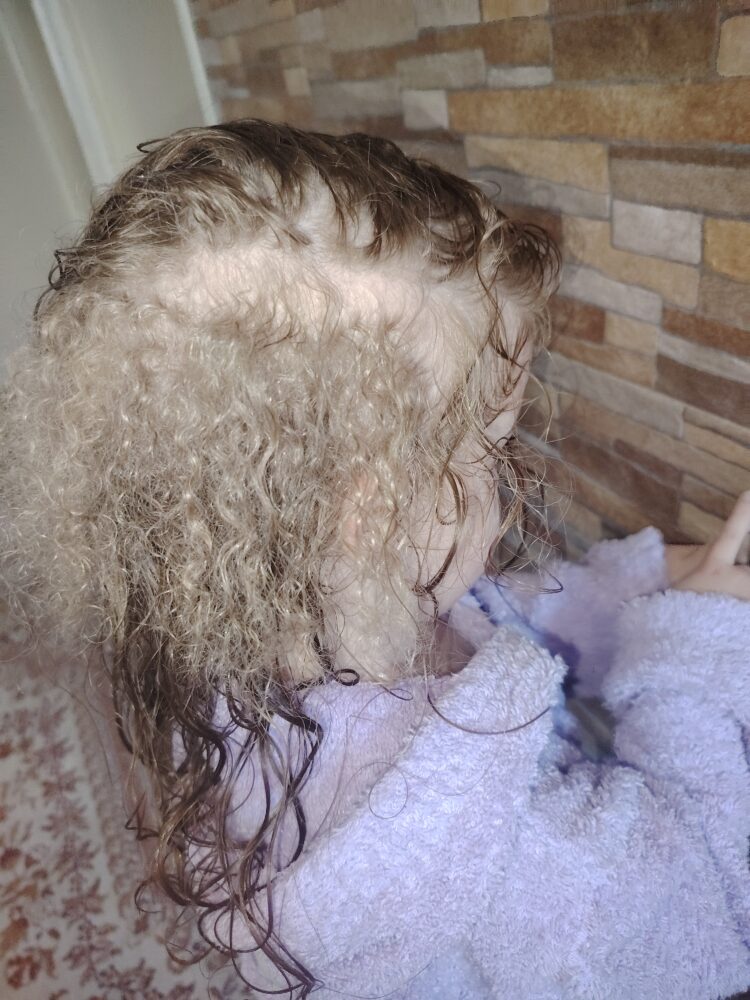 Sofija ima tri godine i tri vrste kose, ljekari zbunjeni FOTO