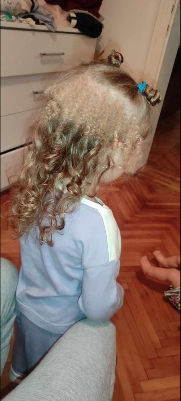 Sofija ima tri godine i tri vrste kose, ljekari zbunjeni FOTO